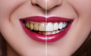 What Is Better, Laser Or Led Teeth Whitening